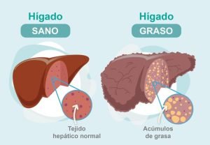 higado-sano-a-higado-graso-ignis-natura