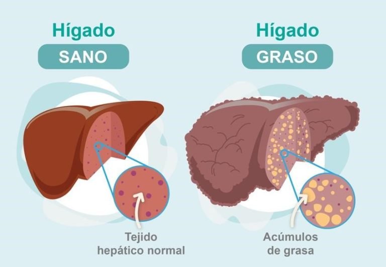 higado-sano-a-higado-graso-ignis-natura