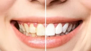 blanquea-dientes-ignis-natura