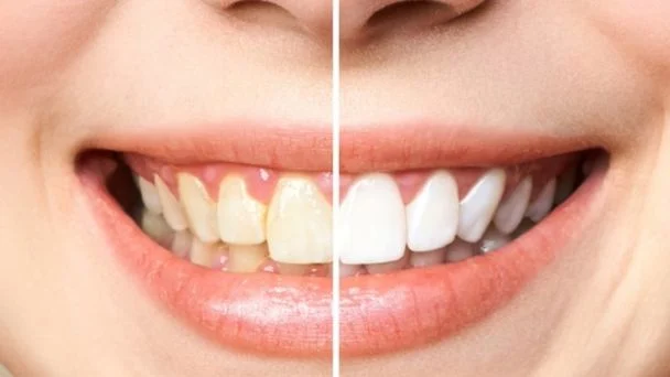 blanquea-dientes-ignis-natura